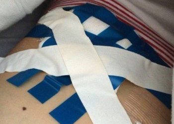 Пациентку из Кемерова после операции перевязали изолентой