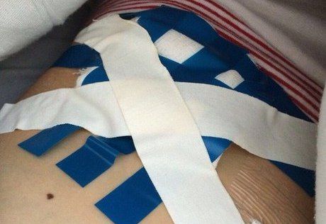 Пациентку из Кемерова после операции перевязали изолентой