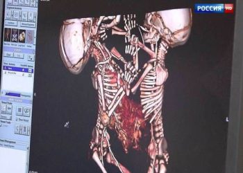Сиамских близнецов из Новосибирска разделили столичные хирурги (видео)
