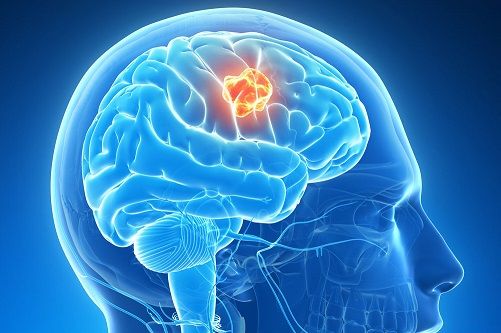 Ученые Новосибирска смогли уничтожить раковые клетки на 99%