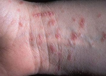 Врачи рассказали, откуда у новосибирцев сыпь и зуд после купания и как этого избежать