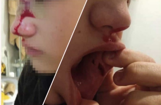 Подкараулили и напали толпой: новосибирец обвинил детей мигрантов в избиении 14-летнего сына