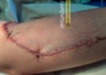 Маленькая школьница из Кыштовки порвала себе руку во время перемены