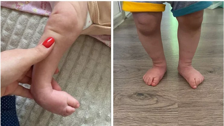 Мальчика с врожденной тяжелой деформацией стоп вылечили новосибирские врачи