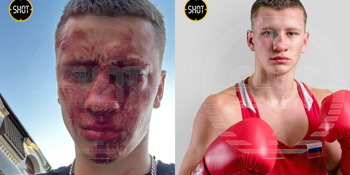 Чемпион России по боксу Дмитрий Двали заступился за ребенка и лишился глаза