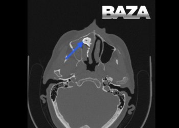 Россиянка несколько лет жила с орехом в носу