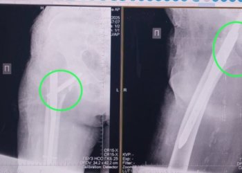 Новосибирские врачи успешно прооперировали 91-летнюю женщину с переломом шейки бедра