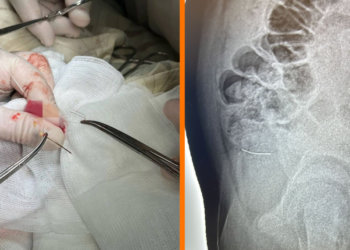 Корсажную булавку из живота мальчика достали сибирские врачи