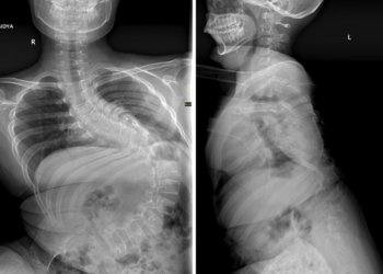 Мальчика с тяжелейшим сколиозом прооперировали новосибирские врачи