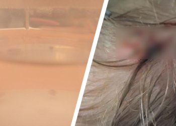 Врачи удалили восемь личинок овечьего овода из головы ребенка в Новосибирске